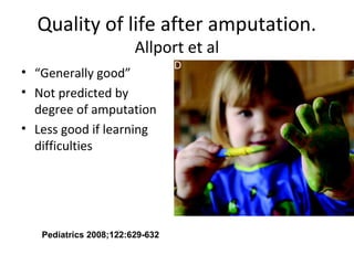 Quality of life after amputation.
Allport et al
• “Generally good”
• Not predicted by
degree of amputation
• Less good if learning
difficulties
Pediatrics 2008;122:629-632
 