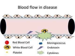 Blood flow in disease
Red Blood Cell
White Blood Cell
Platelet
Meningococcus
Endotoxin
Cytokines
 
