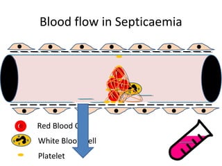 Blood flow in Septicaemia
Red Blood Cell
White Blood Cell
Platelet
 