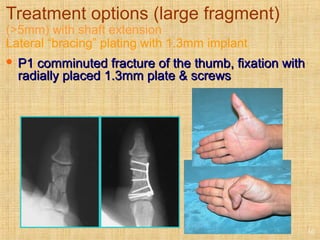 Treatment options (large fragment)
(>5mm) with shaft extension
Lateral “bracing” plating with 1.3mm implant
 P1 comminuted fracture of the thumb, fixation withP1 comminuted fracture of the thumb, fixation with
radially placed 1.3mm plate & screwsradially placed 1.3mm plate & screws
10
 