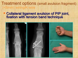 Treatment options (small avulsion fragment)
(<5mm) wiring/K-wire
 Collateral ligament avulsion of PIP joint,Collateral ligament avulsion of PIP joint,
fixation with tension band techniquefixation with tension band technique
12
 
