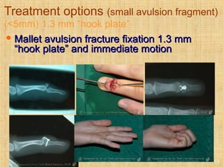 Treatment options (small avulsion fragment)
(<5mm) 1.3 mm “hook plate”
 Mallet avulsion fracture fixation 1.3 mmMallet avulsion fracture fixation 1.3 mm
“hook plate” and immediate motion“hook plate” and immediate motion
13
 