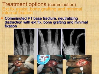 Treatment options (comminution)
Ext fix assist, bone grafting and minimal
internal fixation
15
 Comminuted P1 base fracture, neutralizingComminuted P1 base fracture, neutralizing
distraction with ext fix, bone grafting and minimaldistraction with ext fix, bone grafting and minimal
fixationfixation
 