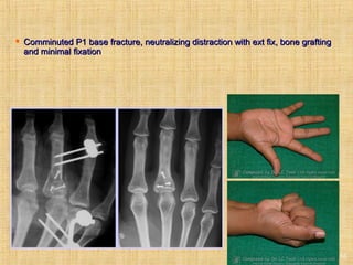 16
 Comminuted P1 base fracture, neutralizing distraction with ext fix, bone graftingComminuted P1 base fracture, neutralizing distraction with ext fix, bone grafting
and minimal fixationand minimal fixation
 