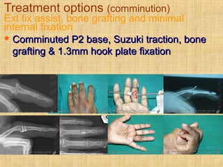 Treatment options (comminution)
Ext fix assist, bone grafting and minimal
internal fixation
 Comminuted P2 base, Suzuki traction, boneComminuted P2 base, Suzuki traction, bone
grafting & 1.3mm hook plate fixationgrafting & 1.3mm hook plate fixation
17
 