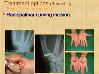 Treatment options (Bennett’s)
(5mm) 1.5 mm implants
Radiopalmar curving incisionRadiopalmar curving incision
18
 