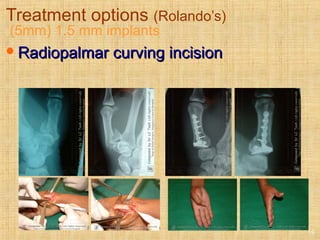Treatment options (Rolando’s)
(5mm) 1.5 mm implants
Radiopalmar curving incisionRadiopalmar curving incision
19
 