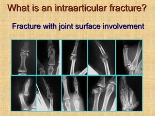 What is an intraarticular fracture?What is an intraarticular fracture?
Fracture with joint surface involvementFracture with joint surface involvement
2
 