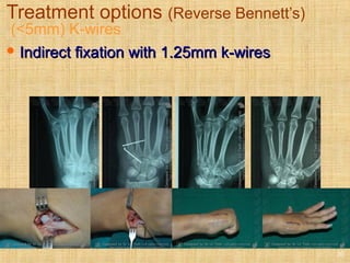 Treatment options (Reverse Bennett’s)
(<5mm) K-wires
 Indirect fixation with 1.25mm k-wiresIndirect fixation with 1.25mm k-wires
20
 