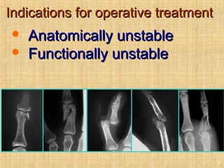 Indications for operative treatmentIndications for operative treatment
 Anatomically unstableAnatomically unstable
 Functionally unstableFunctionally unstable
4
 
