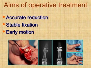 Aims of operative treatment
Accurate reductionAccurate reduction
Stable fixationStable fixation
Early motionEarly motion
5
 
