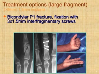 Treatment options (large fragment)
(>5mm) 1.5mm implants
 Bicondylar P1 fracture, fixation withBicondylar P1 fracture, fixation with
3x1.5mm interfragmentary screws3x1.5mm interfragmentary screws
8
 