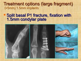 Treatment options (large fragment)Treatment options (large fragment)
(>5mm) 1.5mm implants(>5mm) 1.5mm implants
Split basal P1 fracture, fixation withSplit basal P1 fracture, fixation with
1.5mm condylar plate1.5mm condylar plate
9
 