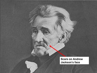Scars on Andrew
Jackson’s face
 