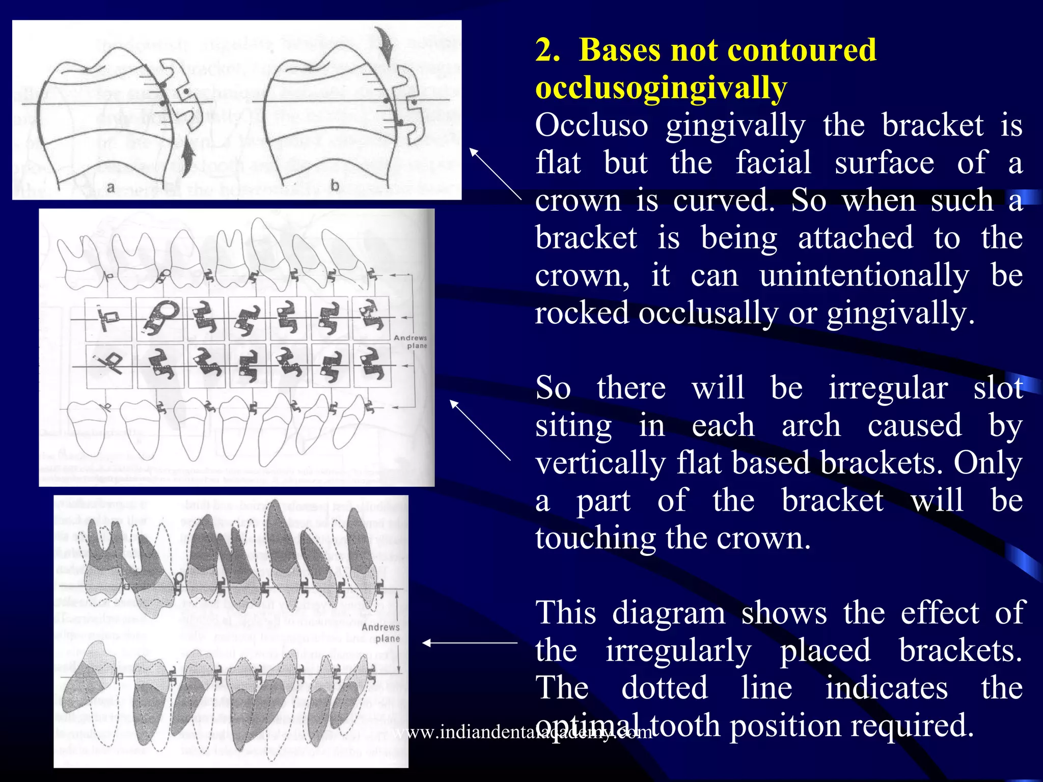 2. Bases not contoured
occlusogingivally
Occluso gingivally the bracket is
flat but the facial surface of a
crown is curved. So when such a
bracket is being attached to the
crown, it can unintentionally be
rocked occlusally or gingivally.
So there will be irregular slot
siting in each arch caused by
vertically flat based brackets. Only
a part of the bracket will be
touching the crown.
This diagram shows the effect of
the irregularly placed brackets.
The dotted line indicates the
optimal tooth position required.www.indiandentalacademy.com
 