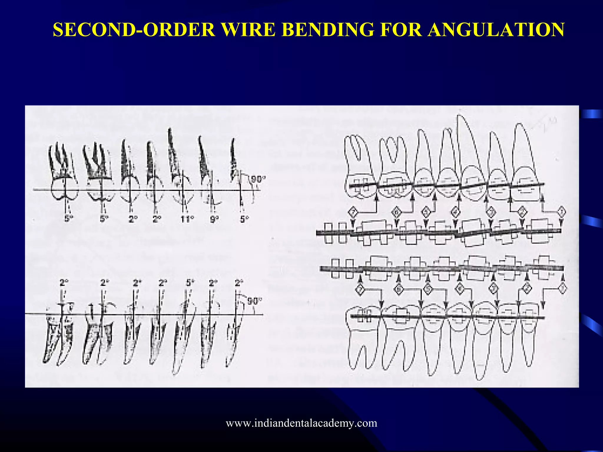 SECOND-ORDER WIRE BENDING FOR ANGULATION
www.indiandentalacademy.com
 