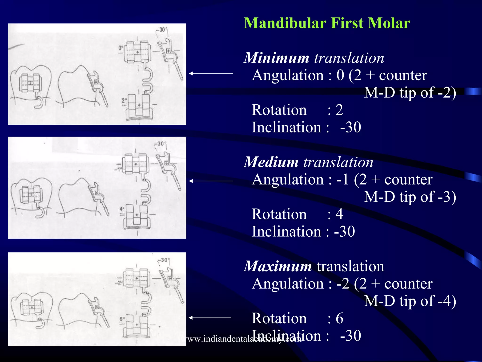 Mandibular First Molar
Minimum translation
Angulation : 0 (2 + counter
M-D tip of -2)
Rotation : 2
Inclination : -30
Medium translation
Angulation : -1 (2 + counter
M-D tip of -3)
Rotation : 4
Inclination : -30
Maximum translation
Angulation : -2 (2 + counter
M-D tip of -4)
Rotation : 6
Inclination : -30www.indiandentalacademy.com
 