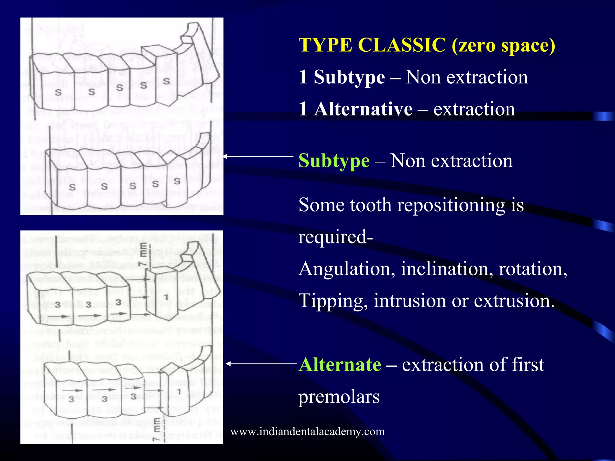 TYPE CLASSIC (zero space)
1 Subtype – Non extraction
1 Alternative – extraction
Subtype – Non extraction
Some tooth repositioning is
required-
Angulation, inclination, rotation,
Tipping, intrusion or extrusion.
Alternate – extraction of first
premolars
www.indiandentalacademy.com
 