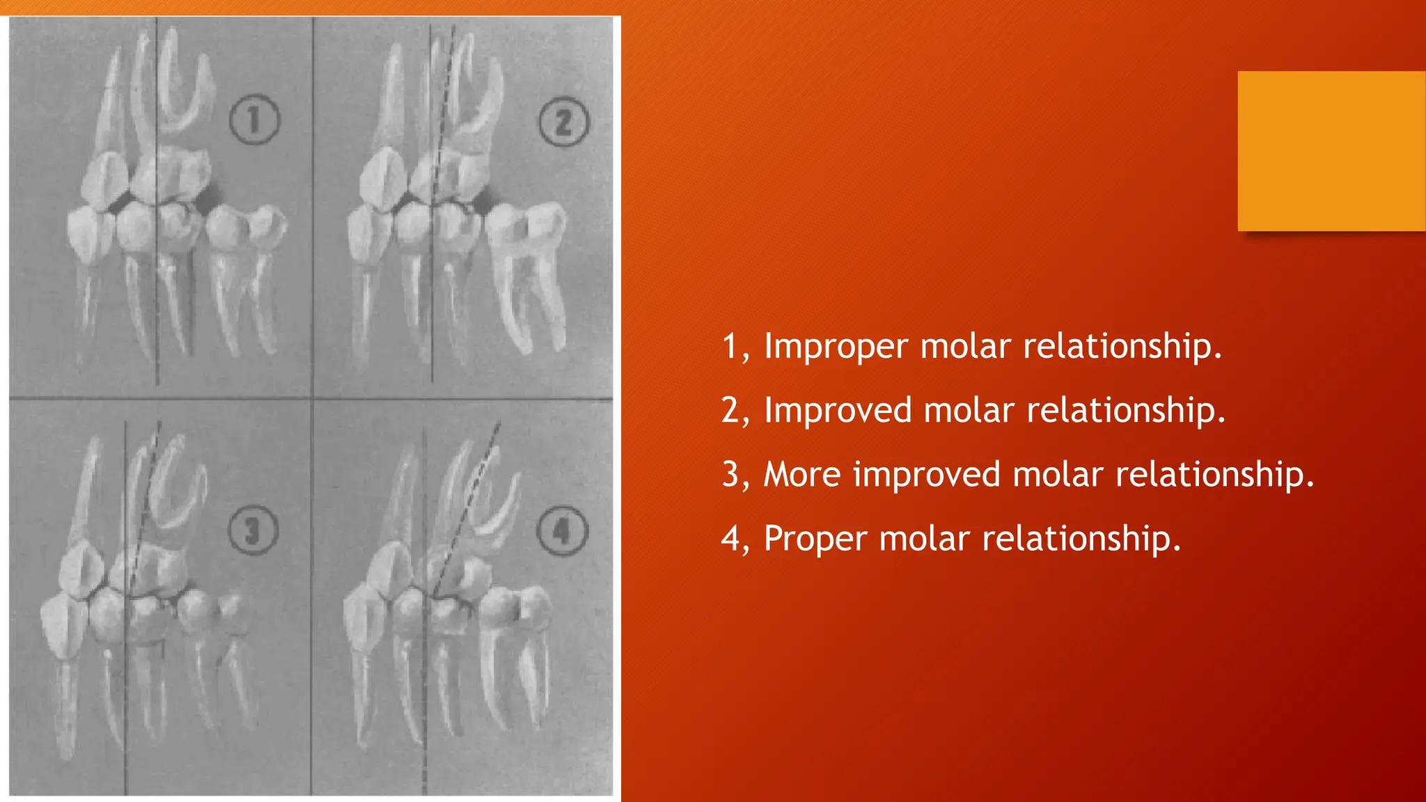 Andrews's six keys of ideal occlusion.pptx