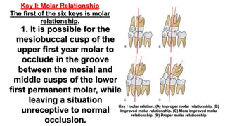 Andrew’s six keys of normal occlusion | PPTX
