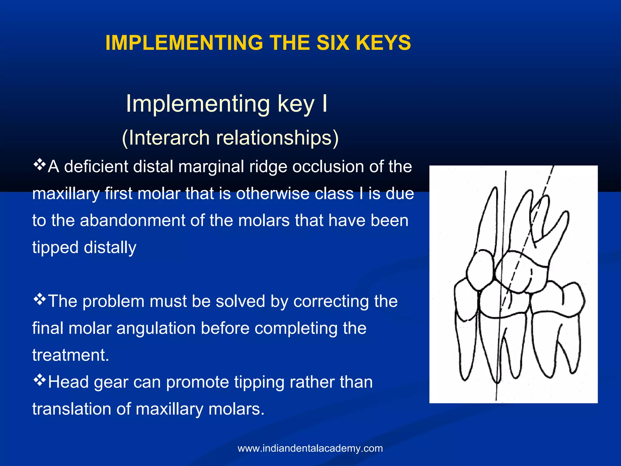 IMPLEMENTING THE SIX KEYS
Implementing key I
(Interarch relationships)
A deficient distal marginal ridge occlusion of the
maxillary first molar that is otherwise class I is due
to the abandonment of the molars that have been
tipped distally
The problem must be solved by correcting the
final molar angulation before completing the
treatment.
Head gear can promote tipping rather than
translation of maxillary molars.
www.indiandentalacademy.com
 