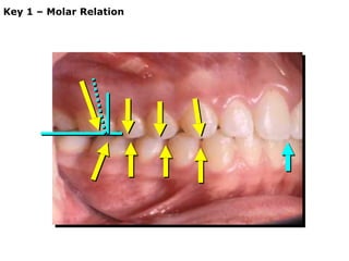 Andrews' six keys to normal occlusion | PDF