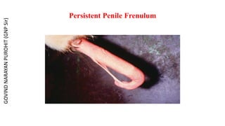 Persistent Penile Frenulum
GOVIND
NARAYAN
PUROHIT
(GNP
Sir)
 