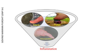 Inflammation
Balanoposthitis
Balanitis Posthitis
GOVIND
NARAYAN
PUROHIT
(GNP
Sir)
 