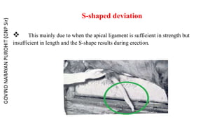 S-shaped deviation
 This mainly due to when the apical ligament is sufficient in strength but
insufficient in length and the S-shape results during erection.
GOVIND
NARAYAN
PUROHIT
(GNP
Sir)
 