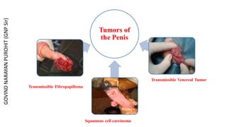 Tumors of
the Penis
Transmissible Fibropapilloma
Squamous cell carcinoma
Transmissible Venereal Tumor
GOVIND
NARAYAN
PUROHIT
(GNP
Sir)
 