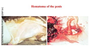 Hematoma of the penis
GOVIND
NARAYAN
PUROHIT
(GNP
Sir)
 
