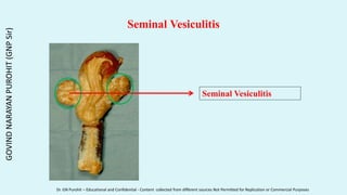 Seminal Vesiculitis
Seminal Vesiculitis
GOVIND
NARAYAN
PUROHIT
(GNP
Sir)
Dr. GN Purohit – Educational and Confidential - Content collected from different sources Not Permitted for Replication or Commercial Purposes
 