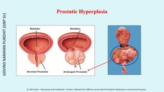 Prostatic Hyperplasia
GOVIND
NARAYAN
PUROHIT
(GNP
Sir)
Dr. GN Purohit – Educational and Confidential - Content collected from different sources Not Permitted for Replication or Commercial Purposes
 