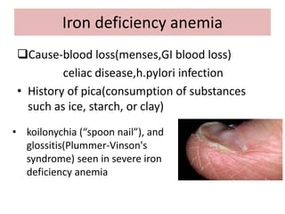 Iron deficiency anemia
Cause-blood loss(menses,GI blood loss)
celiac disease,h.pylori infection
• History of pica(consumption of substances
such as ice, starch, or clay)
• koilonychia (“spoon nail”), and
glossitis(Plummer-Vinson's
syndrome) seen in severe iron
deficiency anemia
 