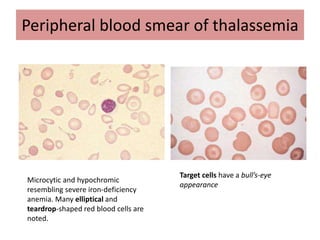 Peripheral blood smear of thalassemia
Microcytic and hypochromic
resembling severe iron-deficiency
anemia. Many elliptical and
teardrop-shaped red blood cells are
noted.
Target cells have a bull’s-eye
appearance
 