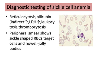 Diagnostic testing of sickle cell anemia
• Reticulocytosis,bilirubin
(indirect↑,LDH↑,leukocy
tosis,thrombocytosis
• Peripheral smear shows
sickle shaped RBCs,target
cells and howell-jolly
bodies
 