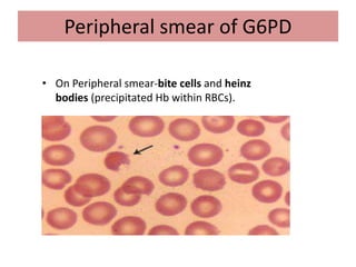 Peripheral smear of G6PD
• On Peripheral smear-bite cells and heinz
bodies (precipitated Hb within RBCs).
 