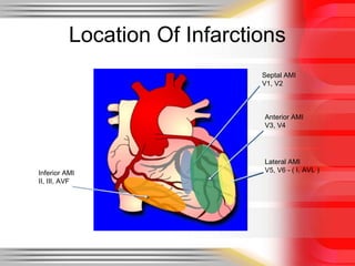 An ECG workshop | PPT