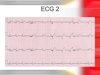 An ECG workshop | PPT