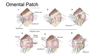 Graham's Patch Gastric Perforation | PPT