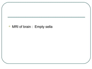  MRI of brain : Empty sella
 