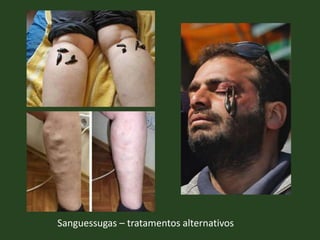 Sanguessugas – tratamentos alternativos
 