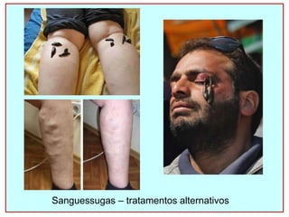 Sanguessugas – tratamentos alternativos
 