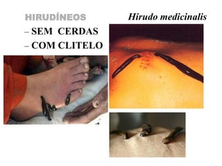 HIRUDÍNEOS      Hirudo medicinalis
– SEM CERDAS
– COM CLITELO
– MONOICOS
 