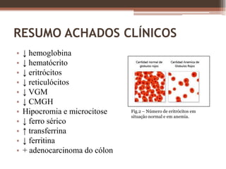 Debrum hemorroidário completo, grau II