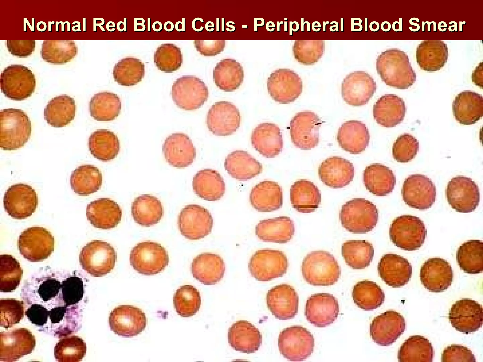 Normal Red Blood Cells - Peripheral Blood Smear 