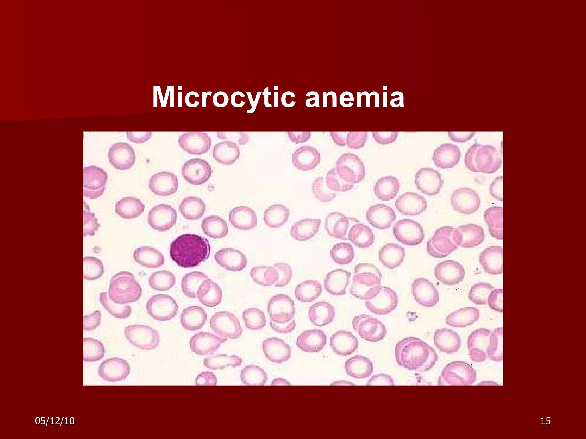 Microcytic anemia 