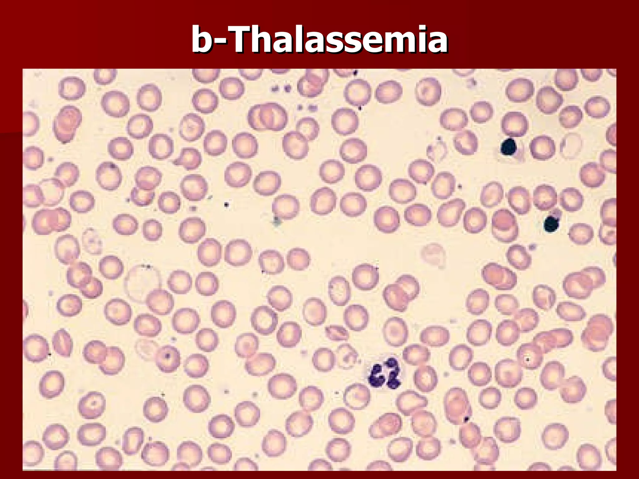 b-Thalassemia 