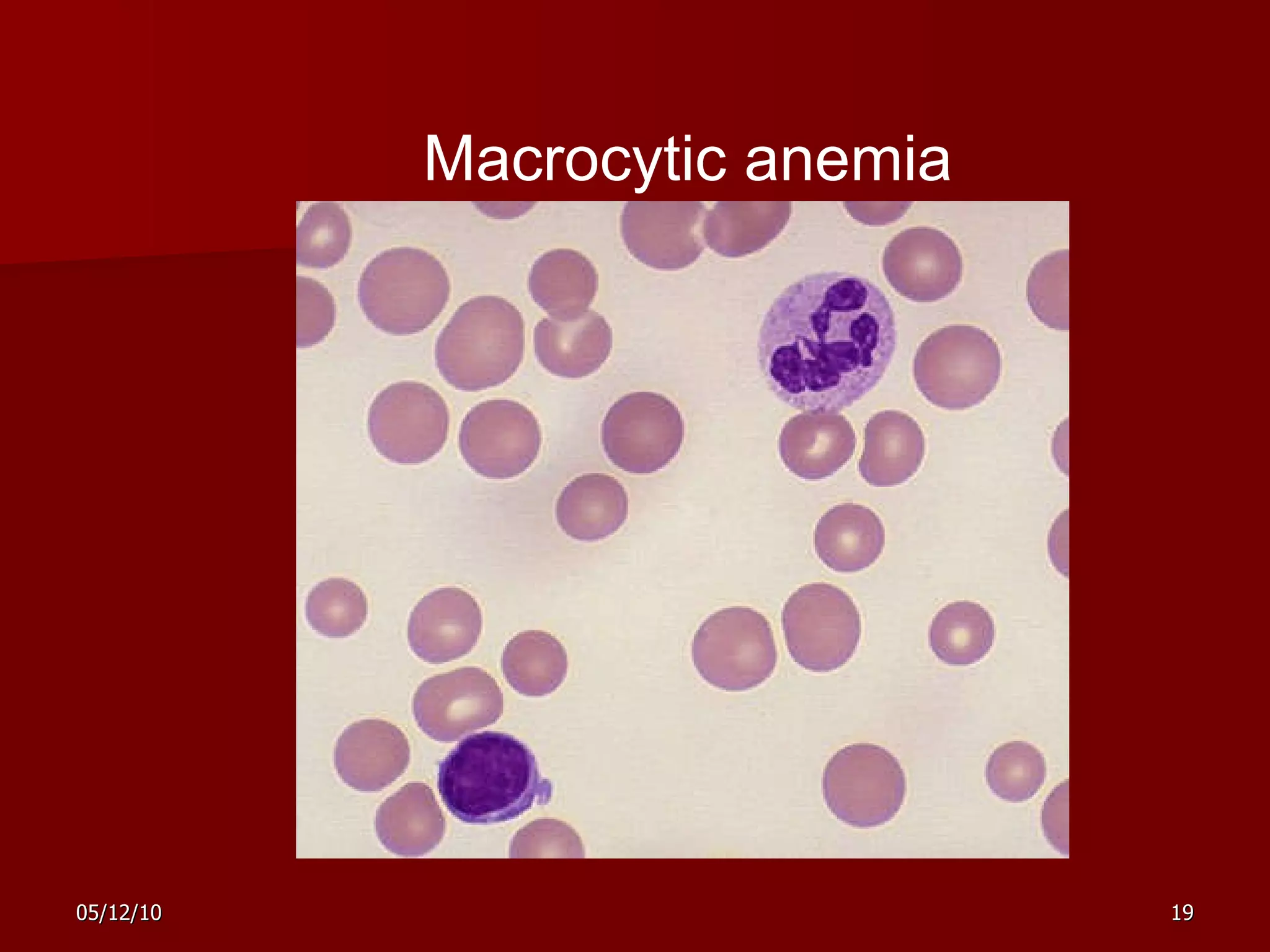   Macrocytic anemia 