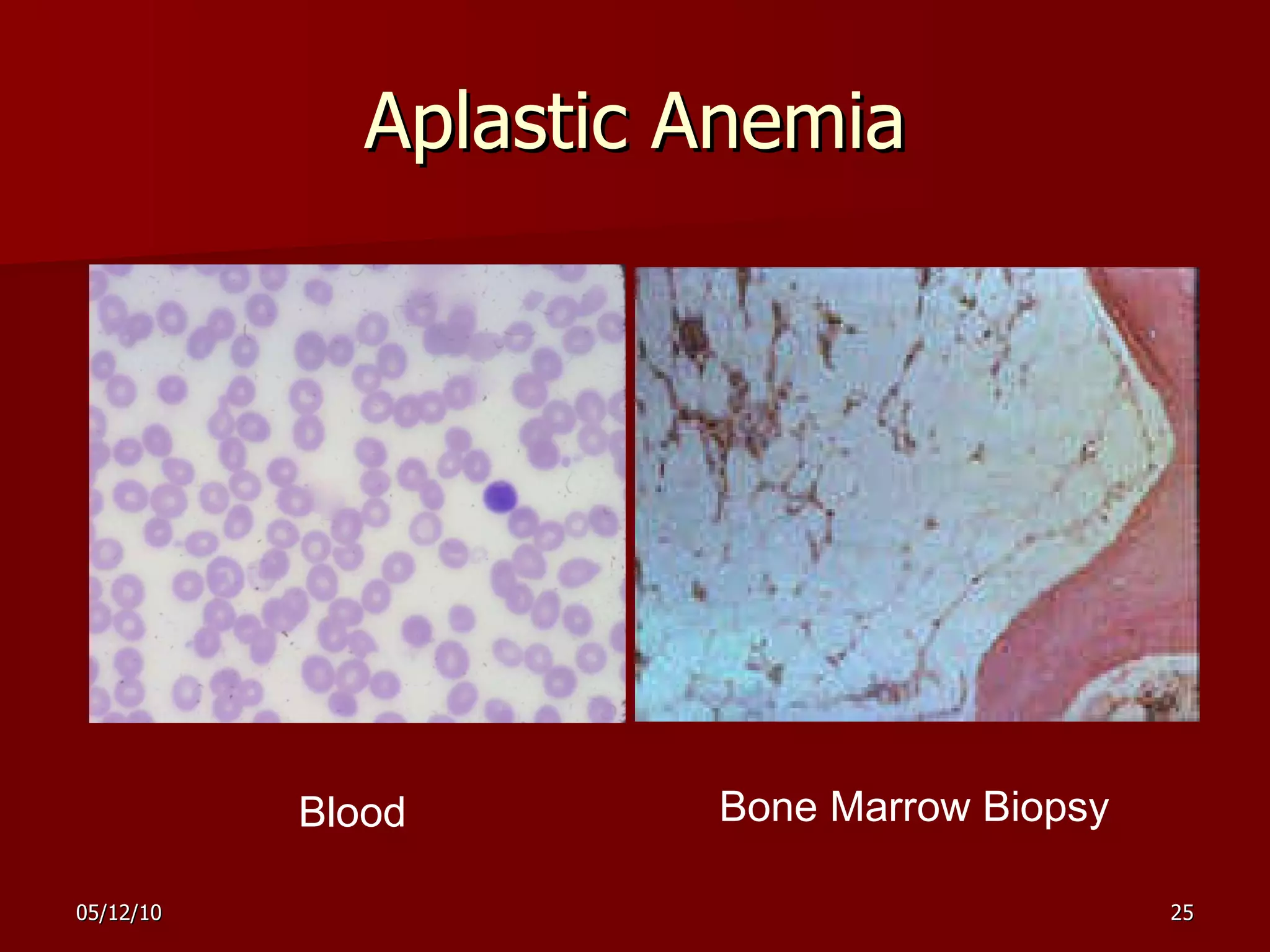 Aplastic Anemia Blood Bone Marrow Biopsy 